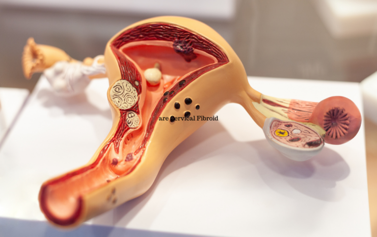 uterus showing fibroids on cervix